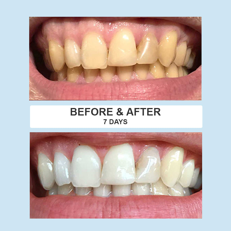 SmilePro Whitening Pen Pack