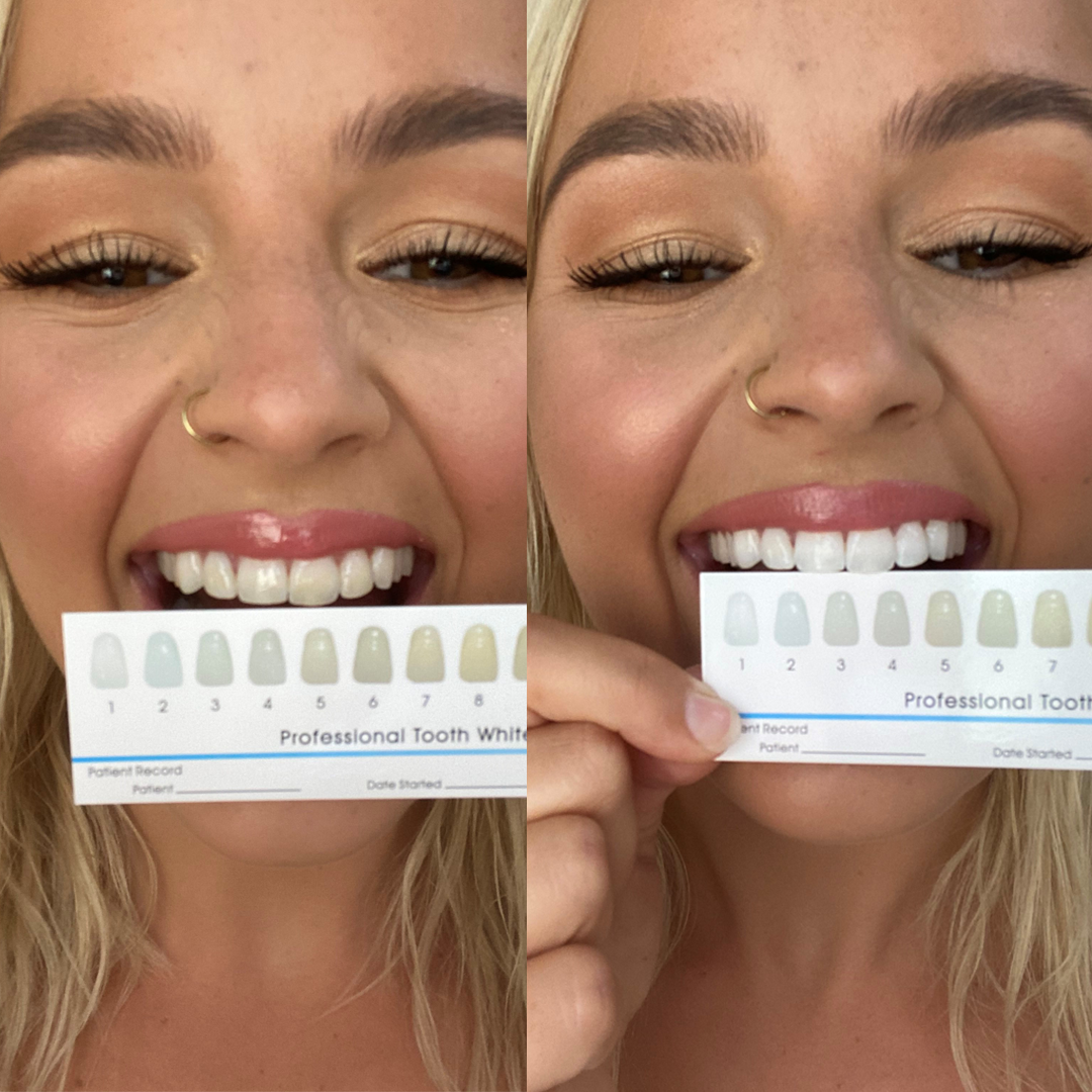 SmilePro Ultimate Whitening Set